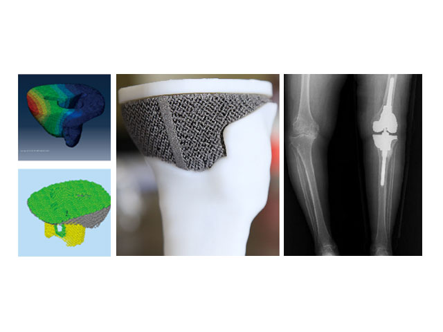 國際首例電子束3D打印多孔鉭植入體 (與西南醫院合作)